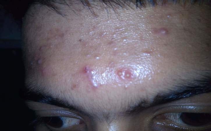 Acne Vulgaris Grade 3