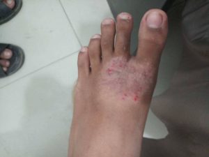 Atopic dermatitis