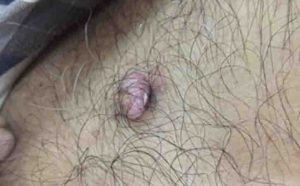 Skin Tag Or Acrochordon Or Soft Fibroma Or Mole In Male Armpit