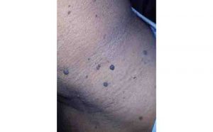 Skin Tags (Acrochordon): Causes and Treatment