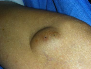 tumor skin lesion