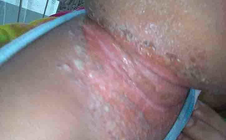 Candidiasis of the skin often causes a red, itchy rash