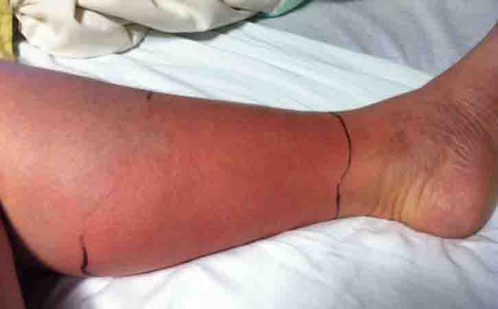 Cellulitis is a common infection of the skin