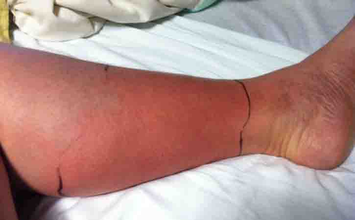 cellulitis leg