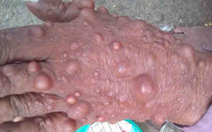 Dermatofibroma diagnosis