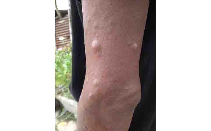 Dermatofibroma, causes and treatments