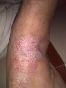 eczema endogeno a lábán vörös folt viszket