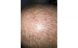 Folliculitis