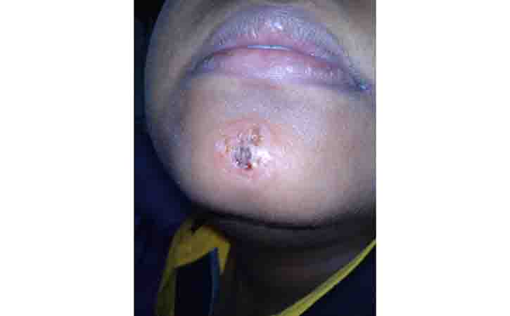 nasal impetigo