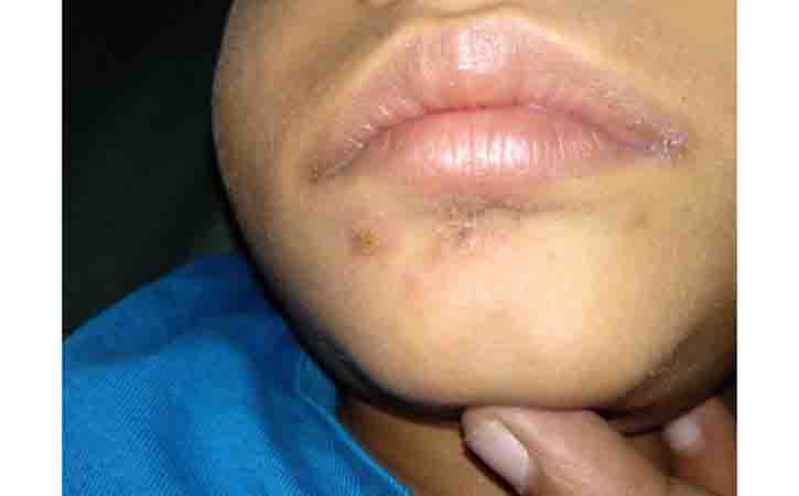 nasal impetigo