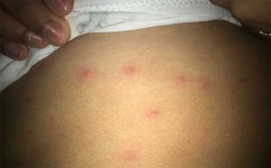 Insect bites