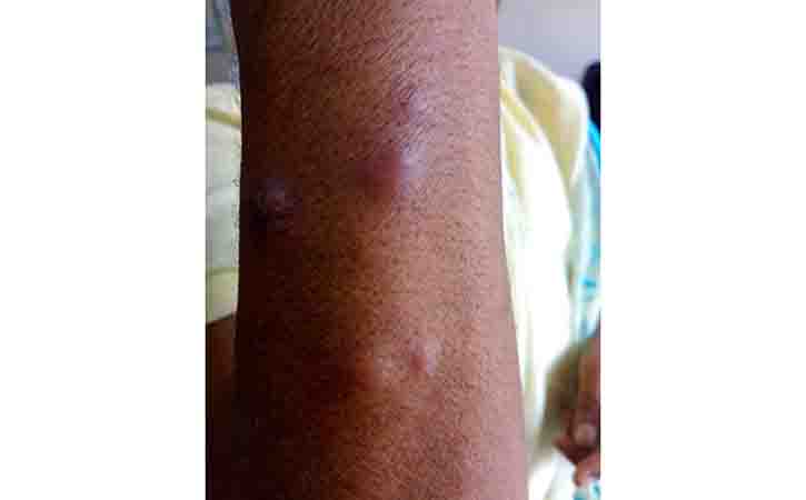 More about Leprosy