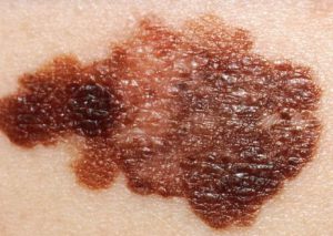 Melanoma