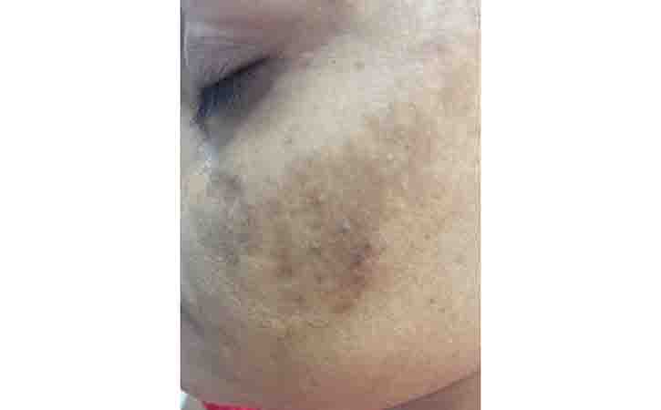 Melasma also known as chloasma faciei