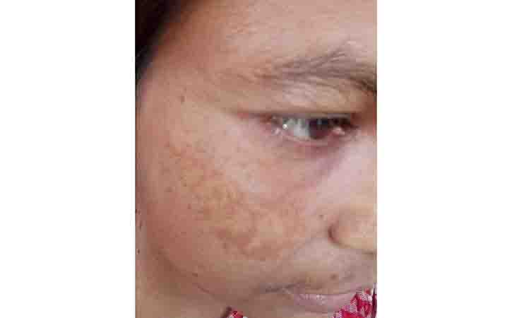 Melasma