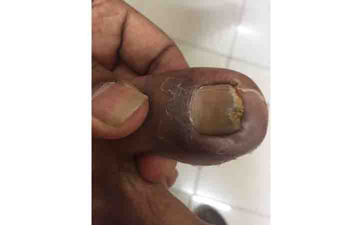 Onychomycosis (Nail Fungus)