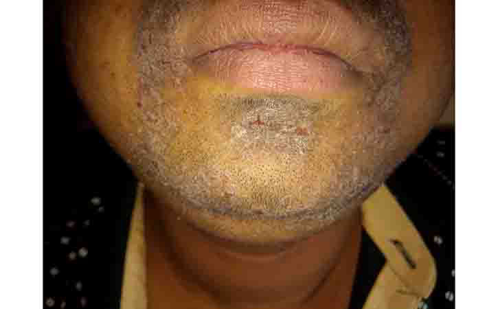 Eczema on the Lips: Causes, Symptoms & Treatment