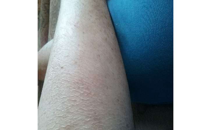 Asteatotic Eczema