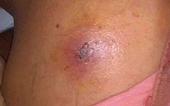 bacterial infection on skin