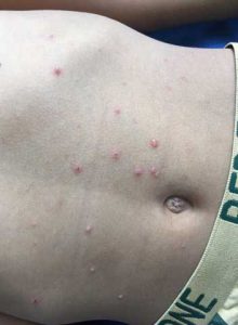 chicken pox on stomach