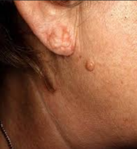 cysts on face