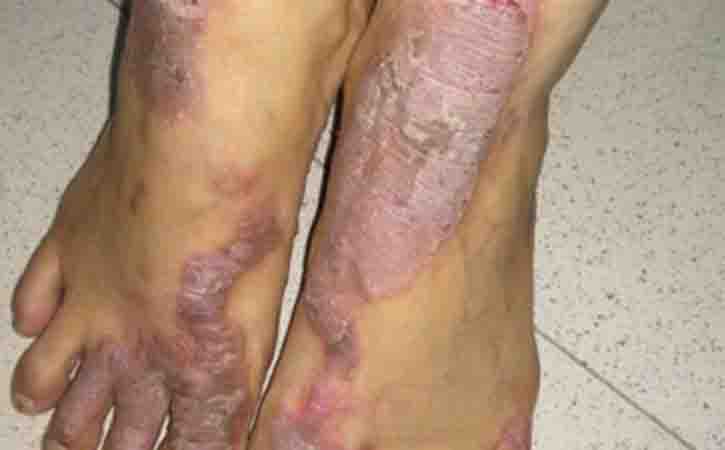 picture of eczema on foot