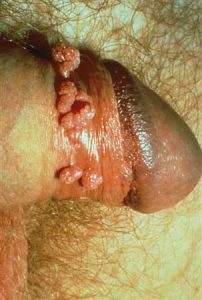 more of genital warts