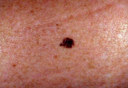 Melanocytic Naevi (Moles): Causes and Treatments | Tibot