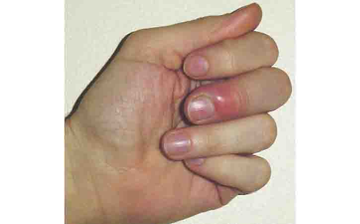 Ouch You Injured a Nail Tips on Best Treatment | Community Healthcare System