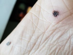 black warts on hands