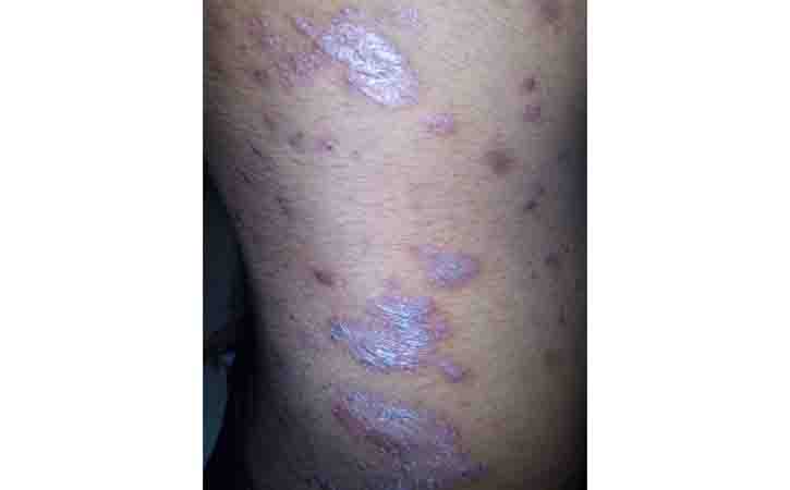 Plaque Psoriasis