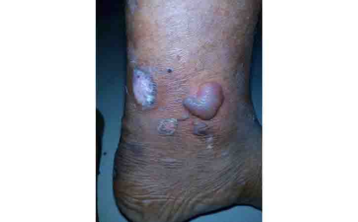 more information about Dyshidrotic eczema (pompholyx)