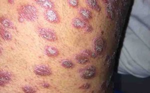 Common Skin Rashes