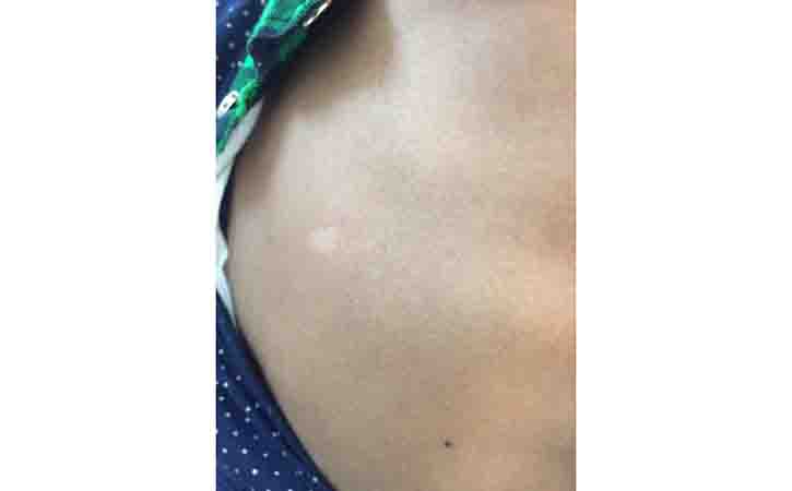 learn more about Pityriasis Alba
