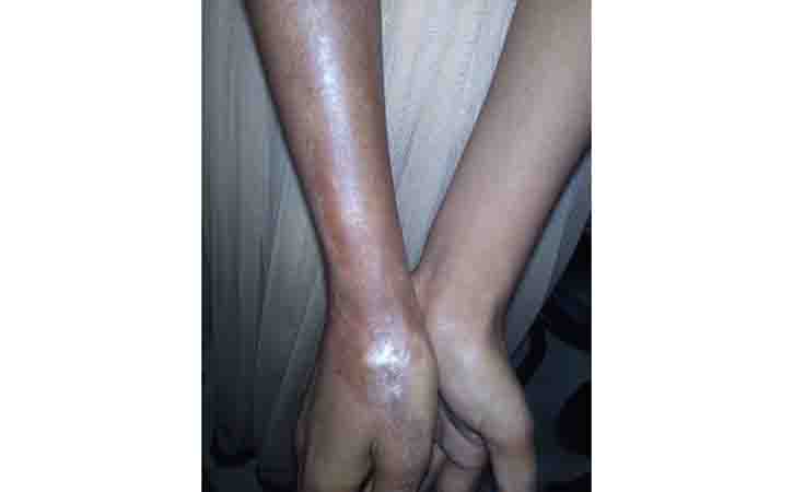 scleroderma skin symptoms