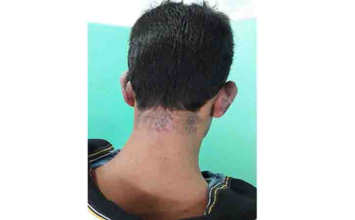 Seborrheic dermatitis is highly treatable but incurable