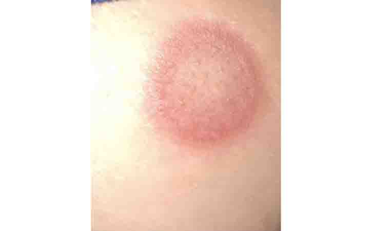 Learn more about Tinea