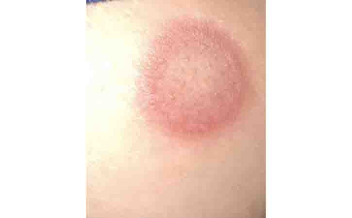 Psoriasis or Fungal Infection Called Tinea Corporis on Leg of