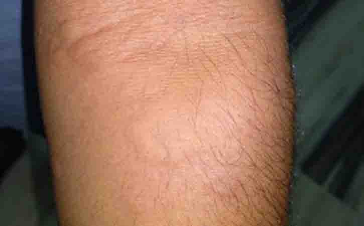 Hives, also known as urticaria