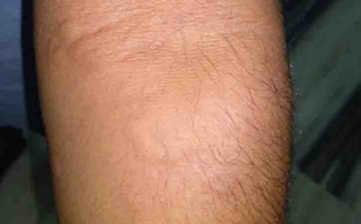 Hives (Urticaria): Symptoms, Causes and Treatment