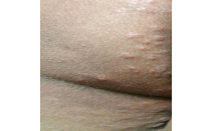 Hives, also known as urticaria