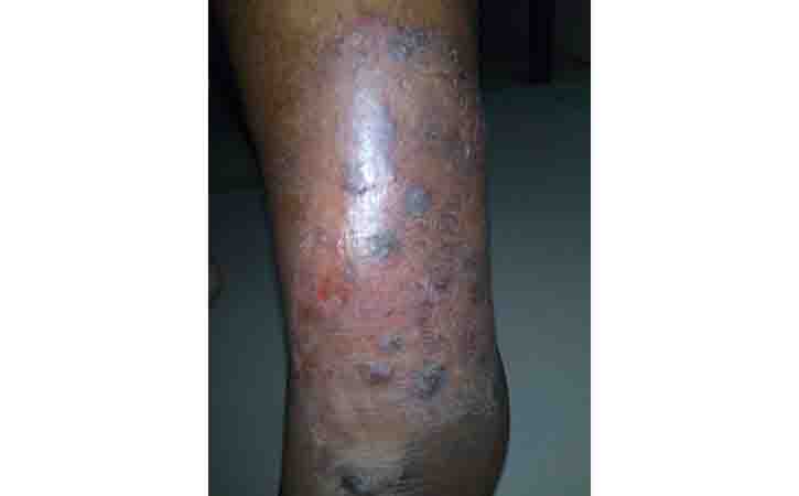 know more about Venous Eczema