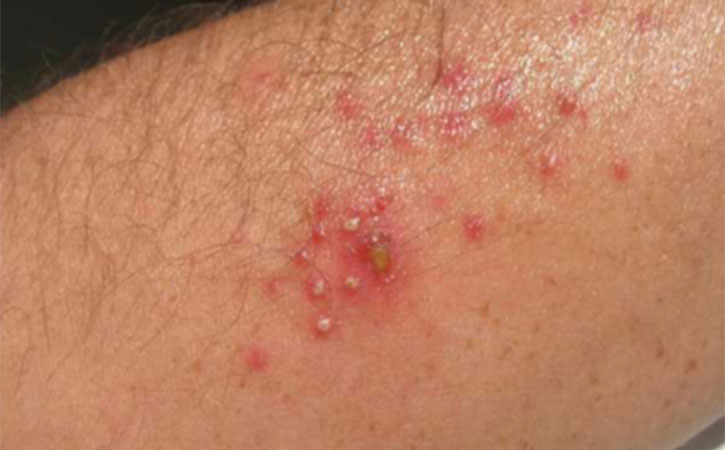 Viral skin infections