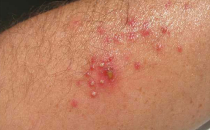 viral skin infections