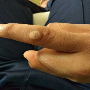 black warts on hands