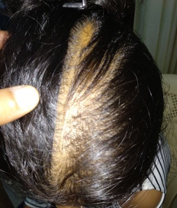 Alopecia in Women Advanced Stage