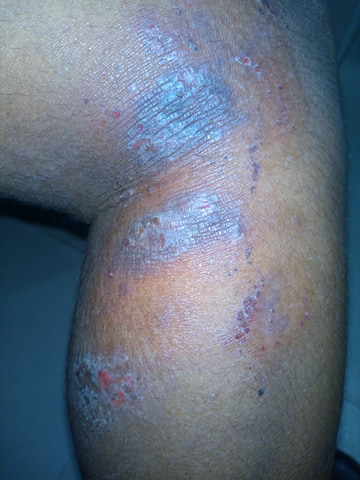 Eczema on legs