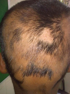 Alopecia Areata