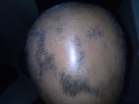 Alopecia Areata Advanced stage