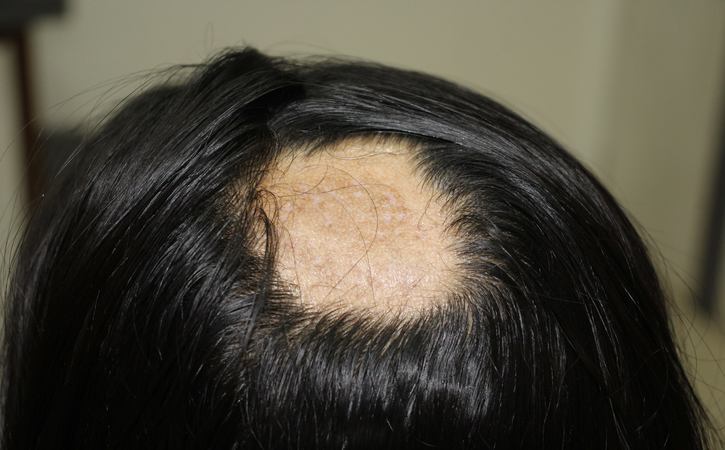 learn more of Alopecia Areata